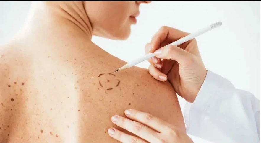 Médecin repérant une lésion cutanée sur le dos d’une patiente